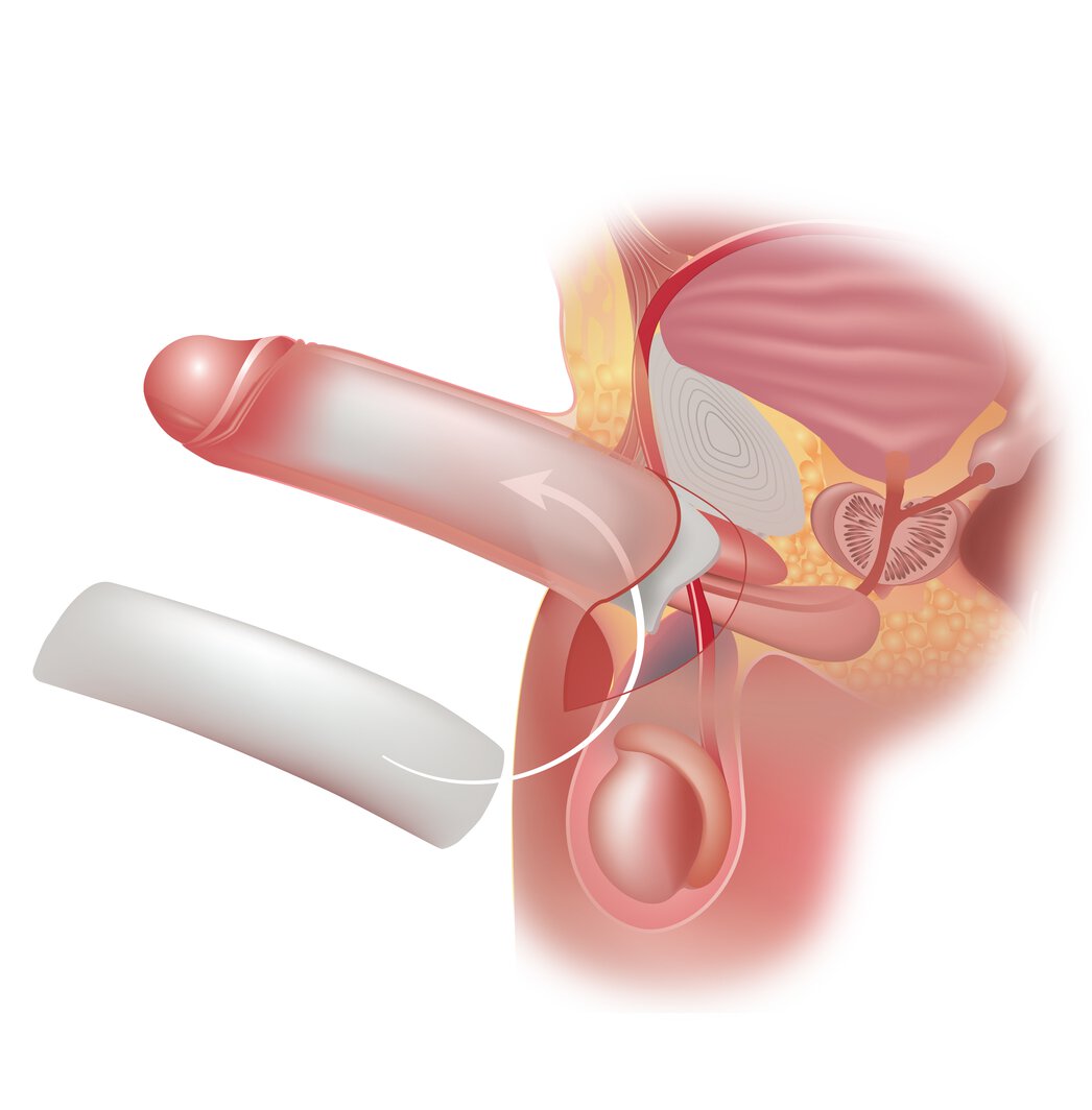 penuma big penis enlargement surgery