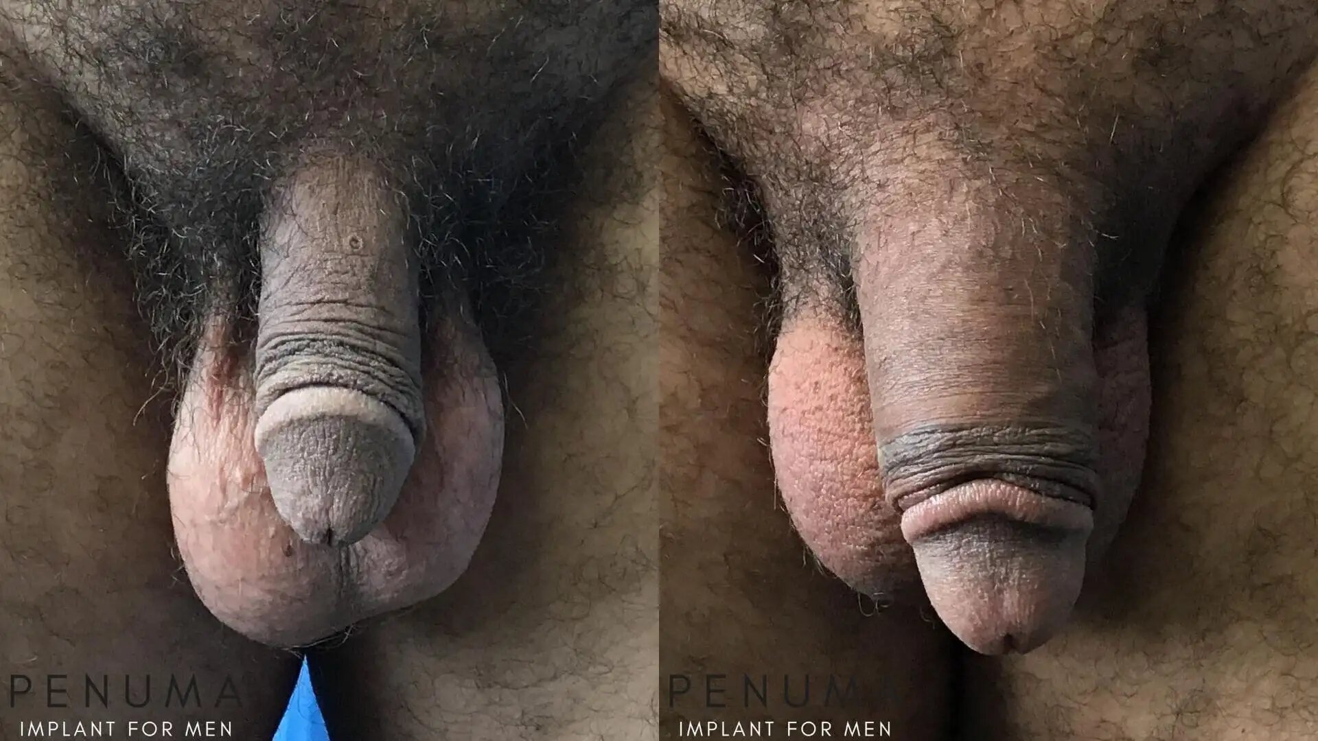 penuma-before-and-after12