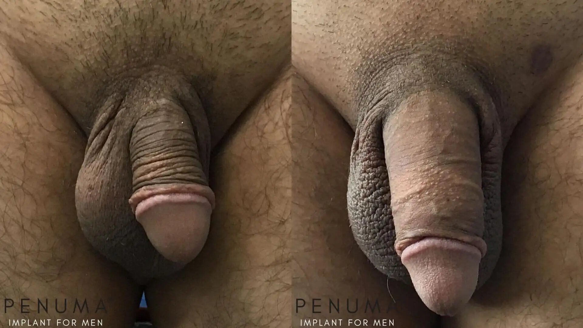 penuma-penis-enlargement4